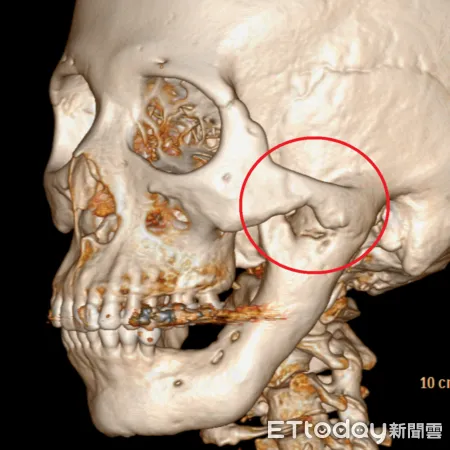 骨骼異常增生術前左顎骨關節沾黏嚴重。（圖／院方提供）