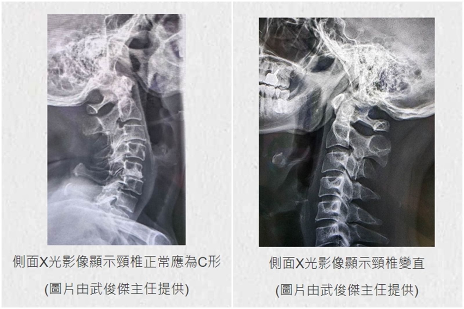 22歲女頭痛2年無解　X光一照！原來是脖子搞的鬼