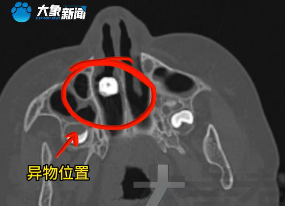 ▲▼7歲男孩鼻子取出顆生鏽螺絲。（圖／翻攝自微博）