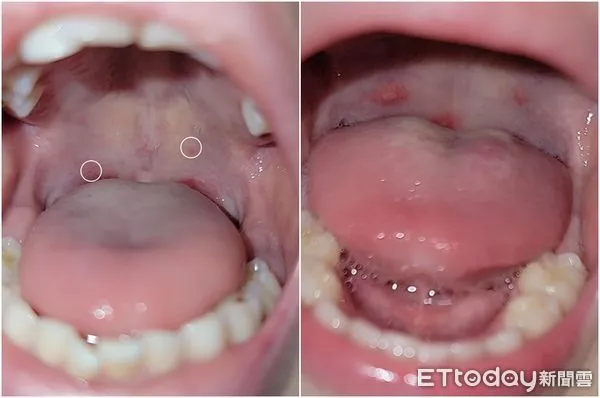 ▲醫2兒接連中鏢「喉嚨整片潰瘍」！　腸病毒9大QA爸媽最常問。（圖／陳世璽醫師授權提供）