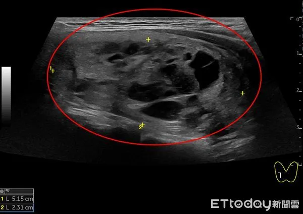 ▲女病患右側5.15公分結節微波消融前，超音波影像。（圖／慈濟醫學中心提供，下同）