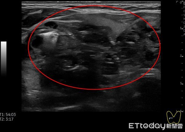 ▲女病患右側5.15公分結節微波消融前，超音波影像。（圖／慈濟醫學中心提供，下同）
