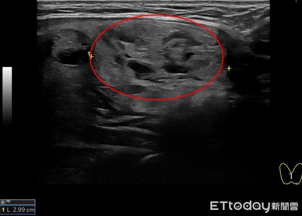 ▲女病患右側5.15公分結節微波消融前，超音波影像。（圖／慈濟醫學中心提供，下同）