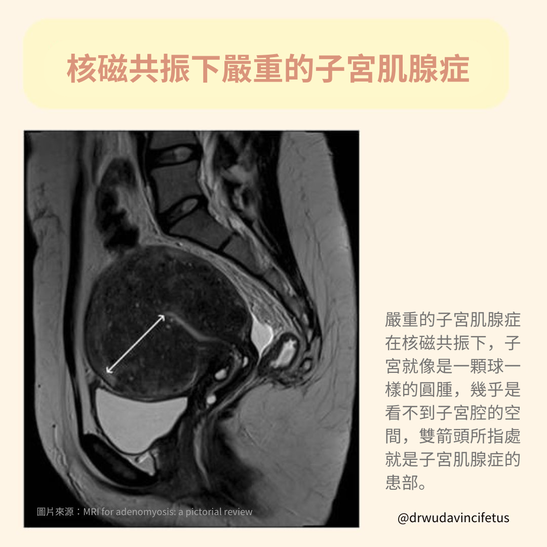 ▲經痛不是「吃冰」的錯？！了解子宮肌腺症的成因與症狀。（圖／問8線上健康諮詢）