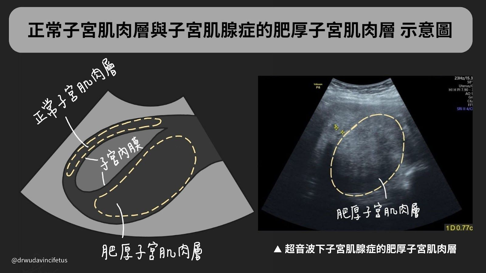 ▲經痛不是「吃冰」的錯？！了解子宮肌腺症的成因與症狀。（圖／問8線上健康諮詢）