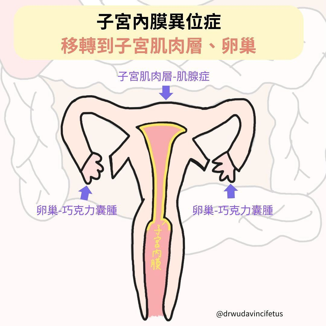 ▲經痛不是「吃冰」的錯？！了解子宮肌腺症的成因與症狀。（圖／問8線上健康諮詢）