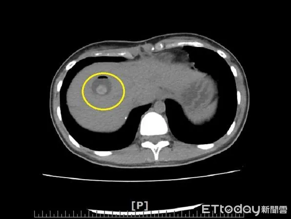 ▲少女罹膽道囊腫致肝內結石，黃圈為結石處。（圖／衛福部南投醫院提供）