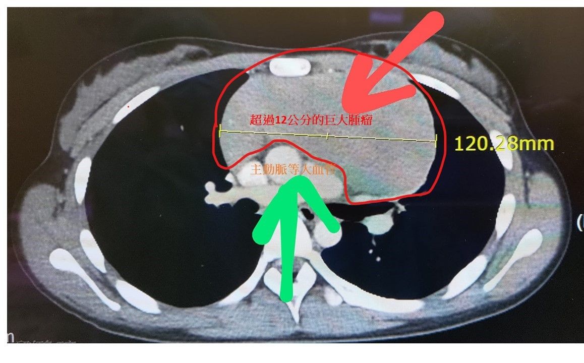 ▲▼13歲妹胸悶「12公分腫瘤壓心臟」！　醫：是罕見淋巴癌。（圖／門諾醫院提供）