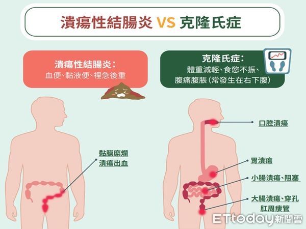 發炎性腸道疾病治療。（圖／醫師提供）