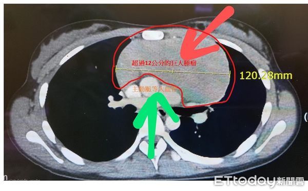 ▲一名13歲的國中女生，因長期感到胸悶不適至本院急診就醫，檢查後竟發現她胸腔裡長了一個超大腫瘤。(圖門諾醫院提供，下同)