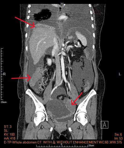 ▲▼49歲女性腹部脹痛就醫竟確認罹患卵巢癌，圖為電腦斷層影像，紅色箭頭為腫瘤處。（圖／馬偕醫院提供）