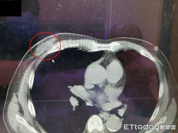 ▲▼乳頭有血！男拖數月求救　醫一壓「突噴出血柱」：是癌症。（圖／大千綜合醫院提供）