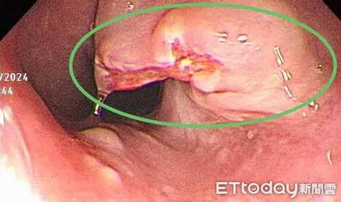 ▲他食道「被腫瘤佔據」！罹癌只有1症狀　醫嘆：確診往往已晚期。（圖／張靖醫師授權提供）