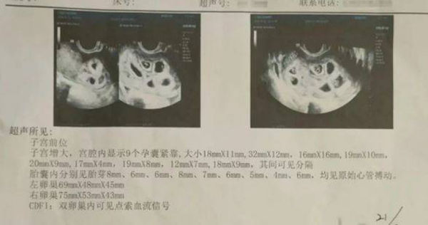 大陸江西省南昌市1名25歲侯姓女子近日到醫院進行產檢，沒想到結果顯示宮腔內有9個孕囊緊靠。（圖／翻攝自瀟湘晨報）