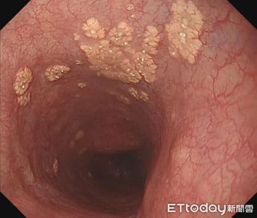▲他照胃鏡驚現「一片片黃色瘤」　醫示警：恐有致命性影響。（圖／詹宜學醫師授權提供）