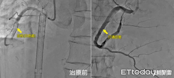 ▲老婦在家看電視心肌梗塞「心臟驟停3次」，裝葉克膜搶命成功。（圖／澄清醫院提供）