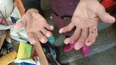 新莊公寓樓梯間疑遭潑強酸　婦人撿回收物雙手遭灼傷