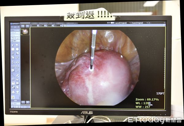 ▲▼ 創新微波消融術 治療子宮肌(腺)瘤傷口小  。（圖／嘉義大林慈濟醫院提供）
