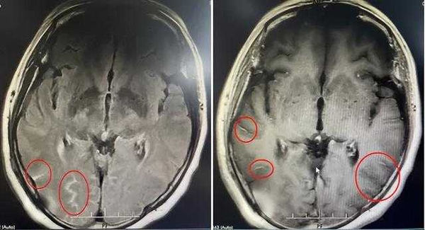 廣東婦頭痛爆炸「確診腦膜炎」　元凶竟是每天買菜…醫示警：死亡率高