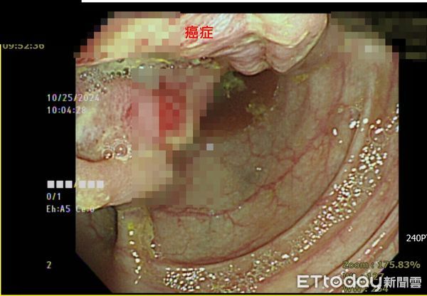 ▲▼年奪6千條命癌症！照大腸鏡「沒問3問題」白做了　醫給忠告。（圖／方冠傑醫師授權提供）