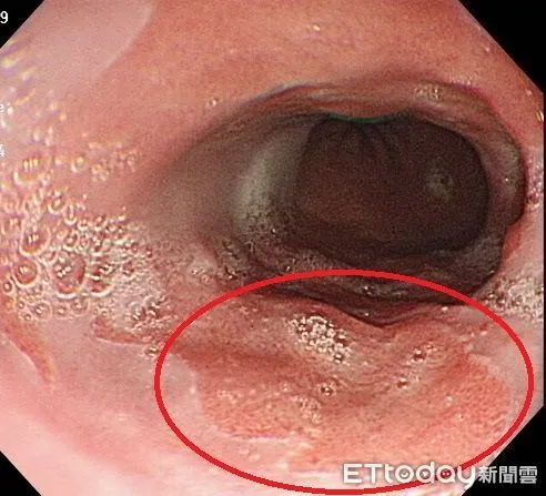 ▲他照胃鏡驚現「一整片鮭魚色」　醫警告：是癌前病變。（圖／張靖醫師授權提供）