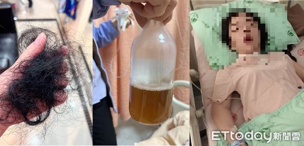 ▲閨蜜揪北上隆乳！術後竟排黑尿、掉髮還淪洗腎怒爆料，診所回應了。（圖／陳小姐提供）