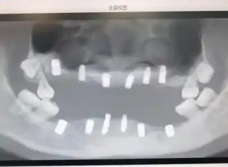 ▲朱小姐只剩4顆牙。（圖／翻攝自微博）