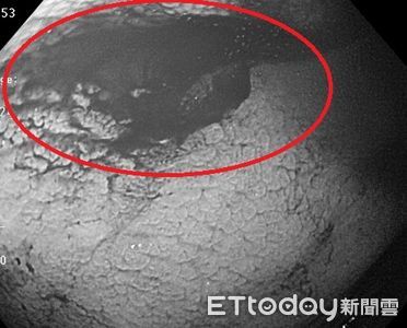 他照大腸鏡「驚見滲血ing」　醫曝病因：不是痔瘡癌症