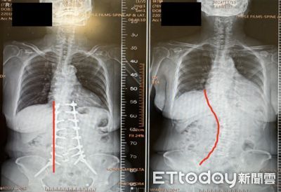 北榮AI手術「秒喬直脊椎側彎」　70歲輪椅嬤術後第2天就下床走