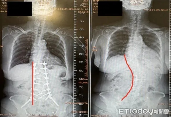 北榮透過AI微創顯微截彎取直脊椎。（圖／北榮提供）