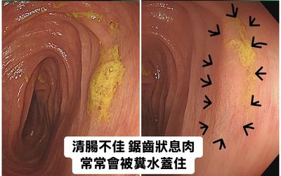 20歲女做大腸鏡　醫一看：我真的嚇到了