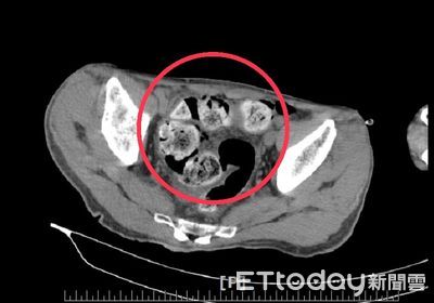 3到5天才大一次...7旬翁忽視長期便祕　導致糞性結腸炎塞破腸道