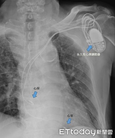 ▲▼心臟調節器。（圖／記者許宥孺翻攝）