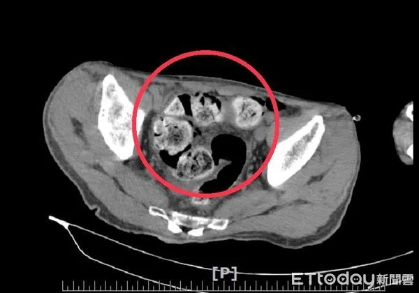 ▲透過電腦斷層影像檢查，可看出蕭姓老翁腸道中有許多糞便。（圖／衛福部南投醫院提供）