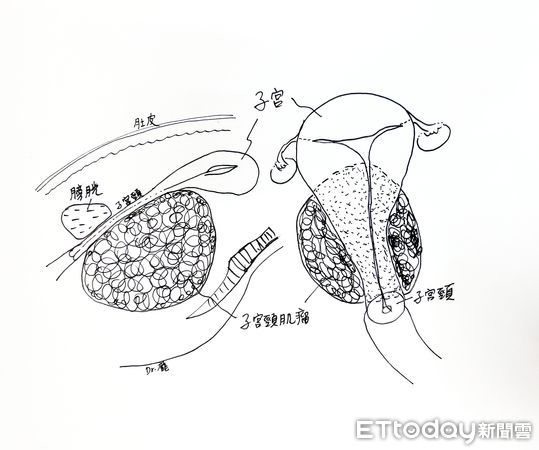 ▲▼左為側面圖，右為正面圖。病人的子宮頸肌瘤大且緊貼子宮內頸，增加了手術難度。（圖／慈濟醫學中心提供，下同