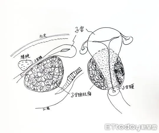 ▲▼左為側面圖，右為正面圖。病人的子宮頸肌瘤大且緊貼子宮內頸，增加了手術難度。（圖／慈濟醫學中心提供，下同