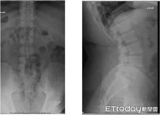 腰椎滑脫導致走路跛行。（圖／北市聯醫提供）