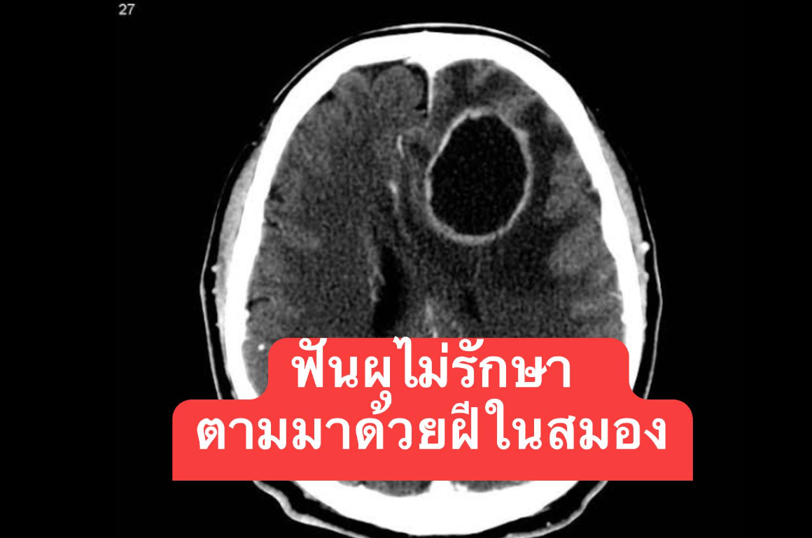 ▲▼婦人蛀牙引發腦膿瘍。（圖／翻攝自Facebook／สาระสมองกับ อจ.หมอสุรัตน์）