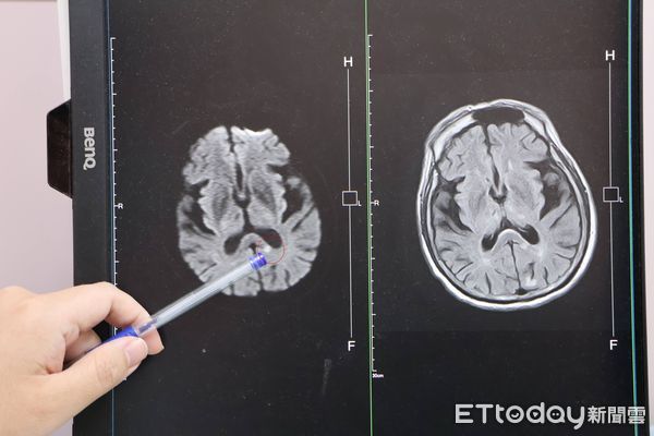 ▲▼台中1名患有三高的男子走路時突然跌倒，醫生研判，天冷造成腦中風。（圖／大甲李綜合醫院提供，下同）