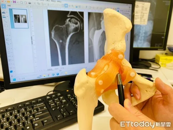 ▲骨中風為支配骨頭的血管阻塞，導致血液無法流通，導致大腿髖關節或股骨頭缺血性壞死。（圖／記者許宥孺翻攝）
