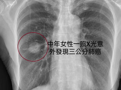 「夫妻都得肺癌」原因曝　醫：這家庭發生什麼事