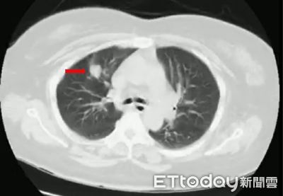 LDCT揪早期肺癌+胸腔鏡輔助微創手術　埔榮創大埔里治癒首例