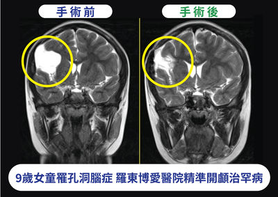 羅東博愛醫院電腦導航系統3D手術　為9歲女童開腦治好癲癇