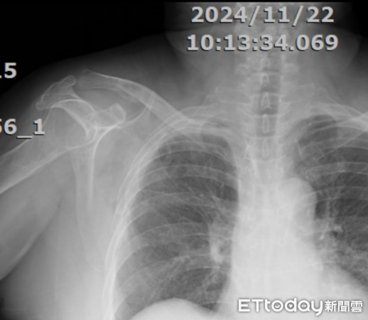 ▲埔榮醫院完成埔里地區首例胸腔鏡輔助微創手術，助患者重拾健康。（圖／台中榮總埔里分院提供）