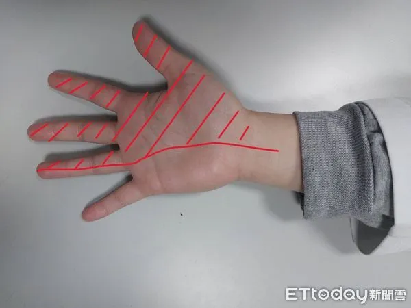 ▲圖1：正中神經壓迫時，手部受影響範圍。（圖／台中榮總埔里分院提供，下同）