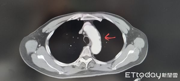 ▲▼吳男被意外發現主動脈弓潰瘍、冠狀動脈狹窄、堵塞；住院期間還突發心肌梗塞，一度情況危急。（圖／門諾醫院提供，下同）