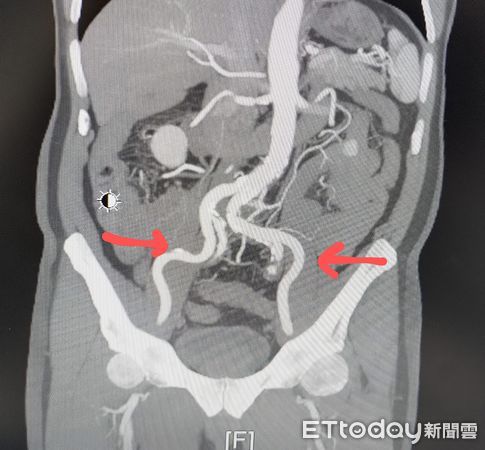 ▲▼吳男被意外發現主動脈弓潰瘍、冠狀動脈狹窄、堵塞；住院期間還突發心肌梗塞，一度情況危急。（圖／門諾醫院提供，下同）