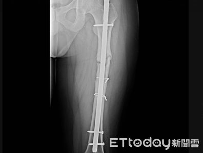 骨釘、鋼板留體內10年「痛到無法走路」　移除後40歲男能跑會跳