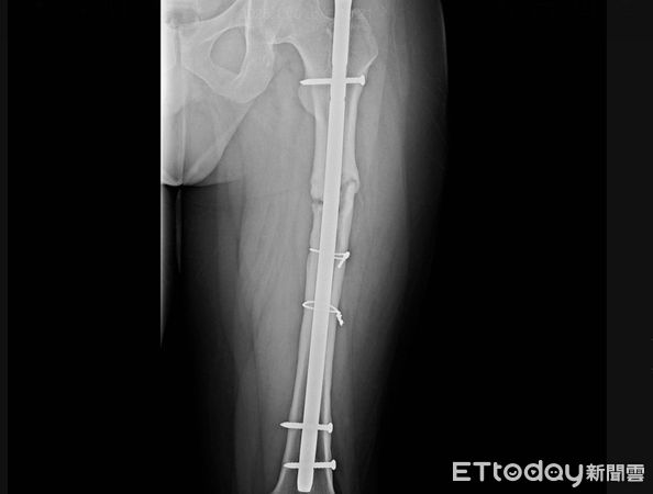 ▲男子車禍左腿打了8支鋼釘及鋼板。（圖／員榮醫院提供）