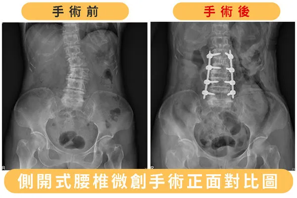 ▲▼羅東博愛醫院脊椎微創手術中心主任陳劍龍醫師表示，若脊椎問題已影響正常生活，建議民眾及早就醫。（圖／羅東博愛醫院提供，下同）